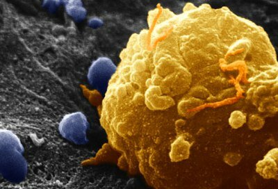 Ученые нашли способ блокировать рецидив рака